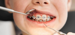 The Role Of Routine Gum Evaluations During Long Term Orthodontic Treatment