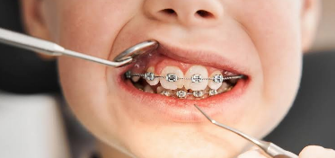 The Role Of Routine Gum Evaluations During Long Term Orthodontic Treatment
